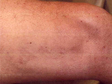 Vein Therapy Dayton OH Patient 82 After