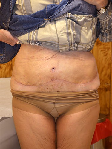 Tummy Tuck Dayton OH Patient 93 After