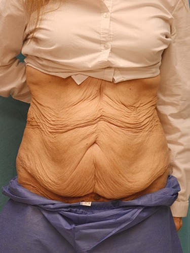 Tummy Tuck Dayton OH Patient 93 Before