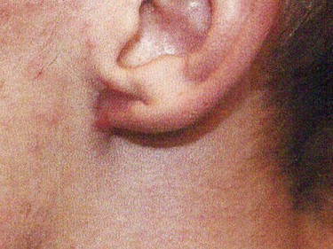 Earlobe Repair Dayton OH Patient 97 After