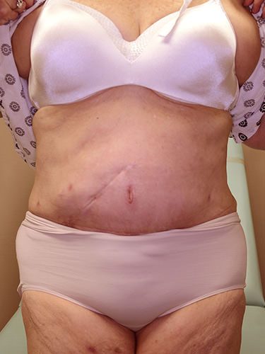 Tummy Tuck Dayton OH Patient 120 After