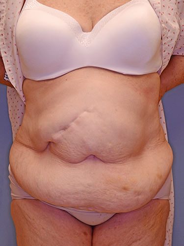 Tummy Tuck Dayton OH Patient 120 Before