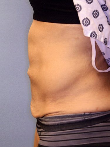 Tummy Tuck Dayton OH Patient 125 Before