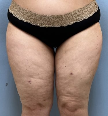 Laser Liposuction Dayton OH Patient 135 After