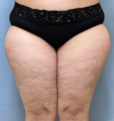 Laser Liposuction Dayton OH Patient 135 Before